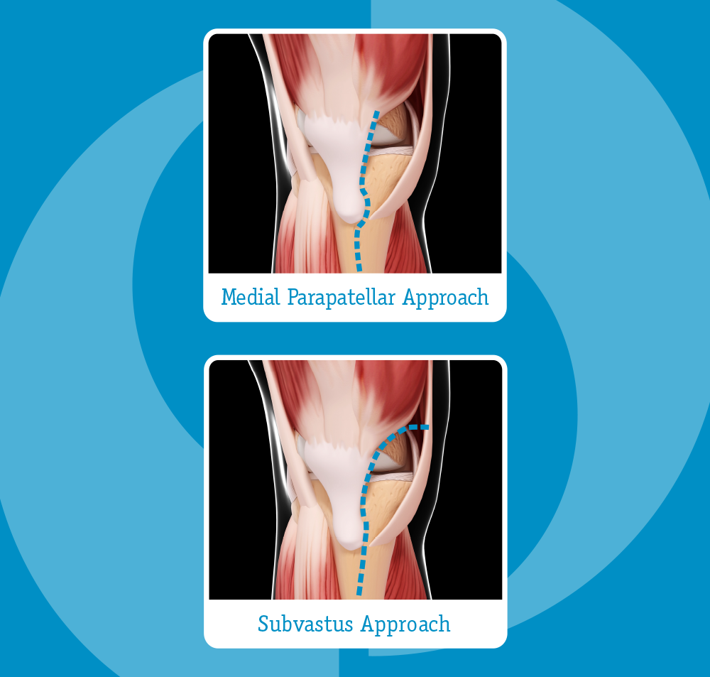 subvastus knee replacement graphic